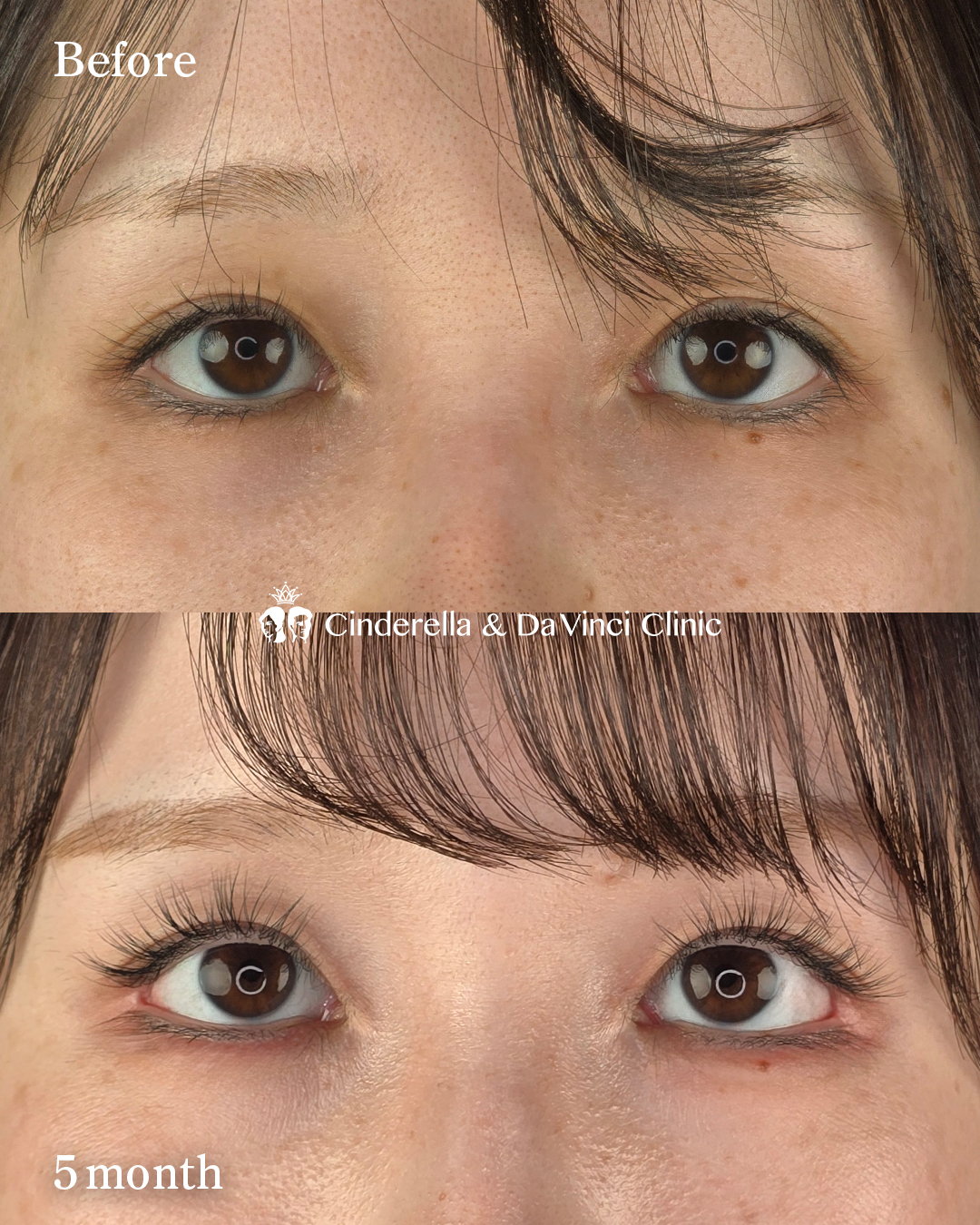 タレ目尻切開の画像