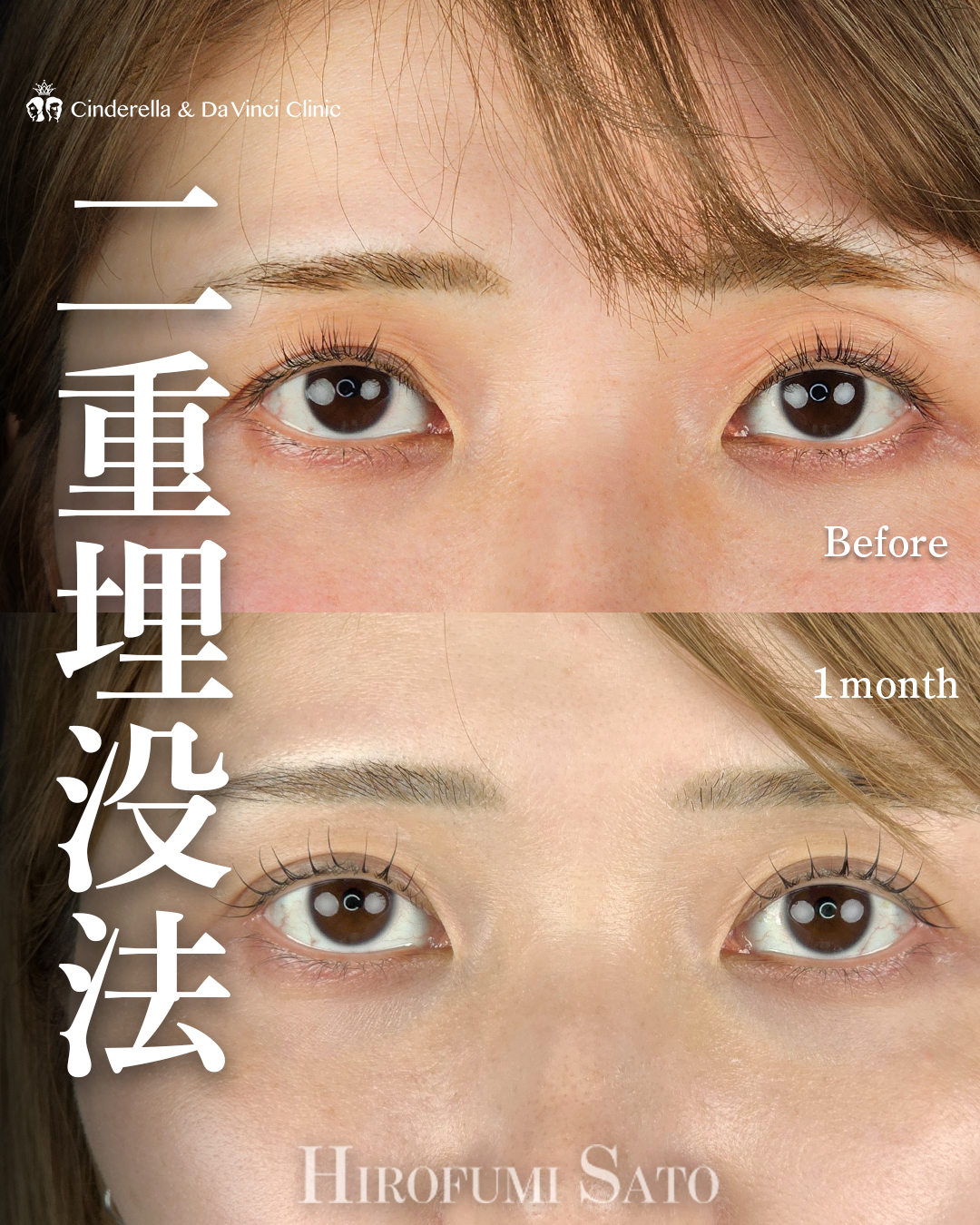 まぶたの皮膚のあまりを埋没で改善