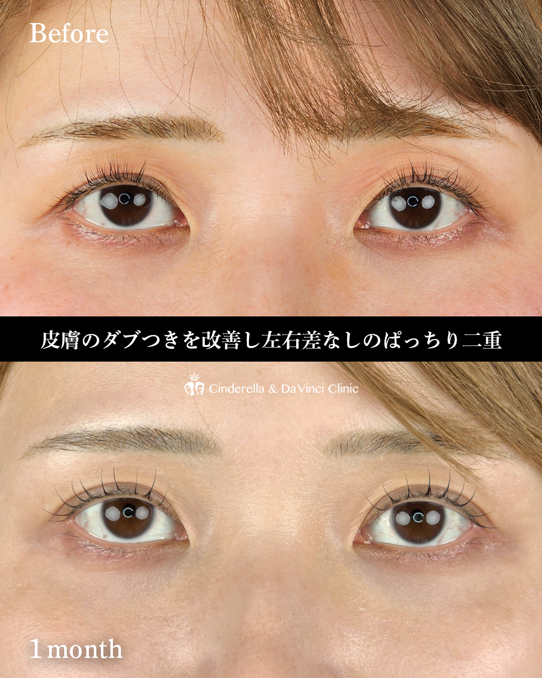 まぶたの皮膚のあまりを埋没で改善の画像