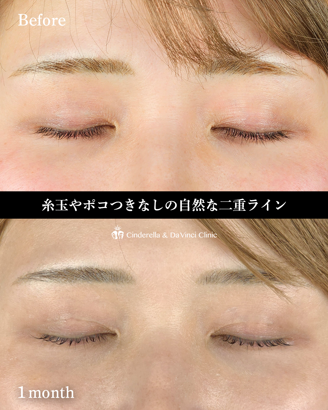 まぶたの皮膚のあまりを埋没で改善の画像