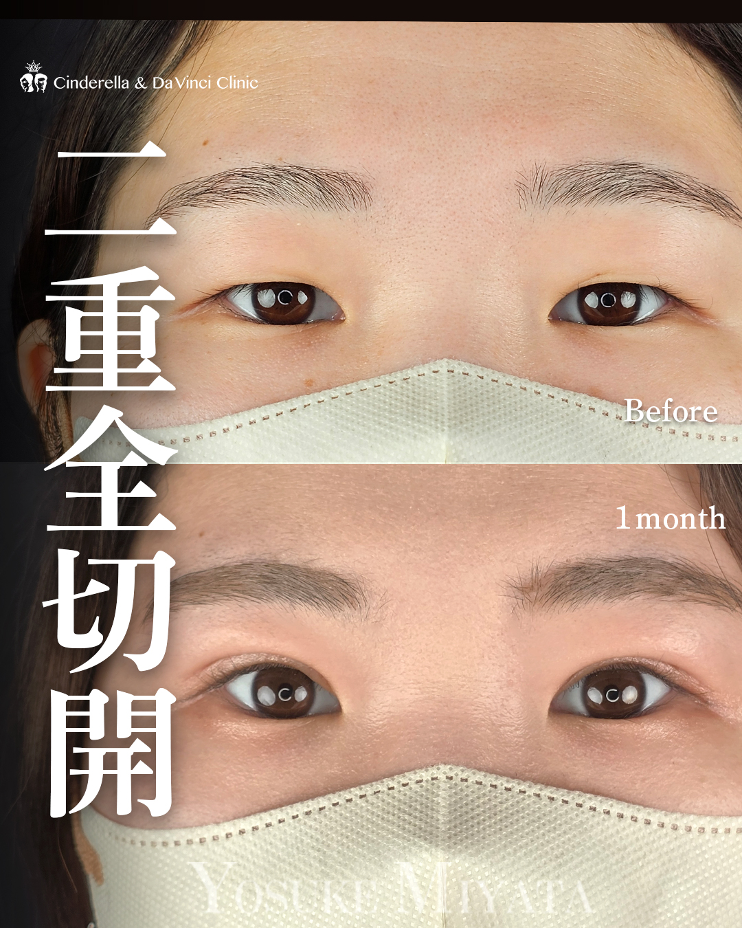 重い一重をぱっちり
