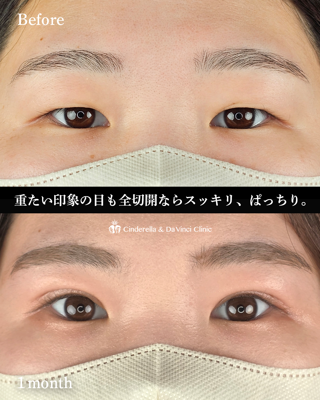 重い一重をぱっちりの画像