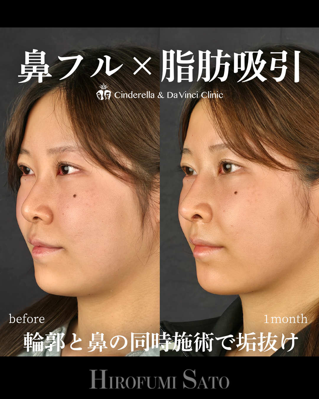 脂肪吸引と鼻整形