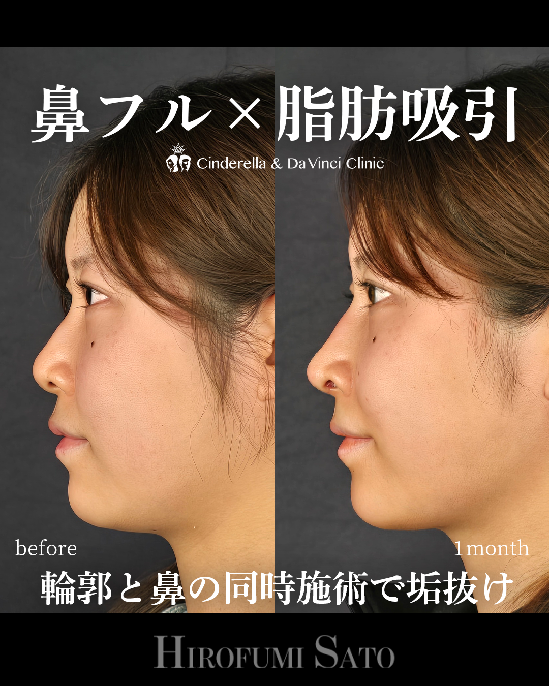 脂肪吸引と鼻整形の画像