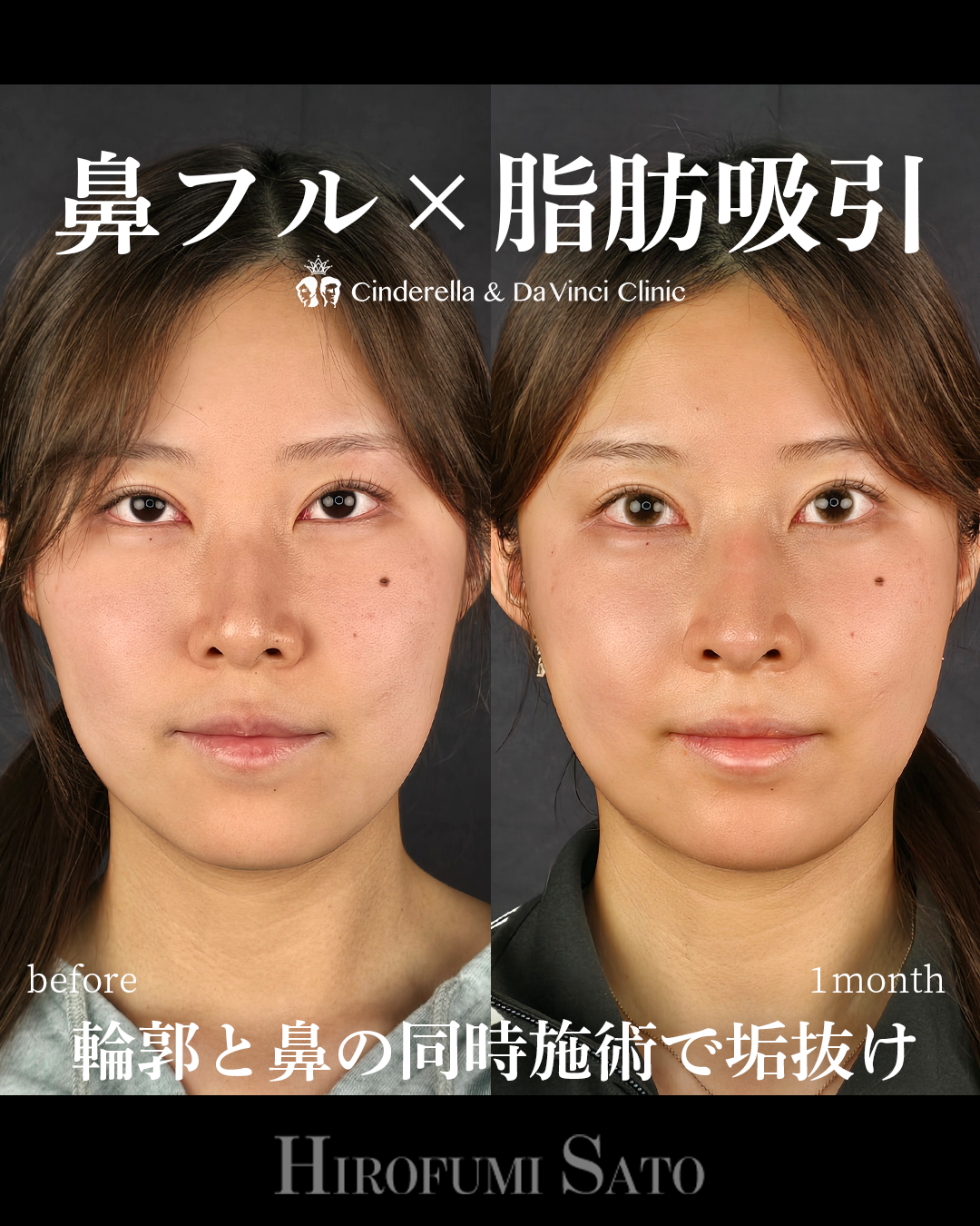 脂肪吸引と鼻整形の画像