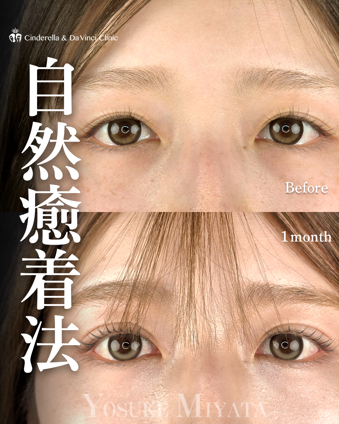 埋没で平行二重