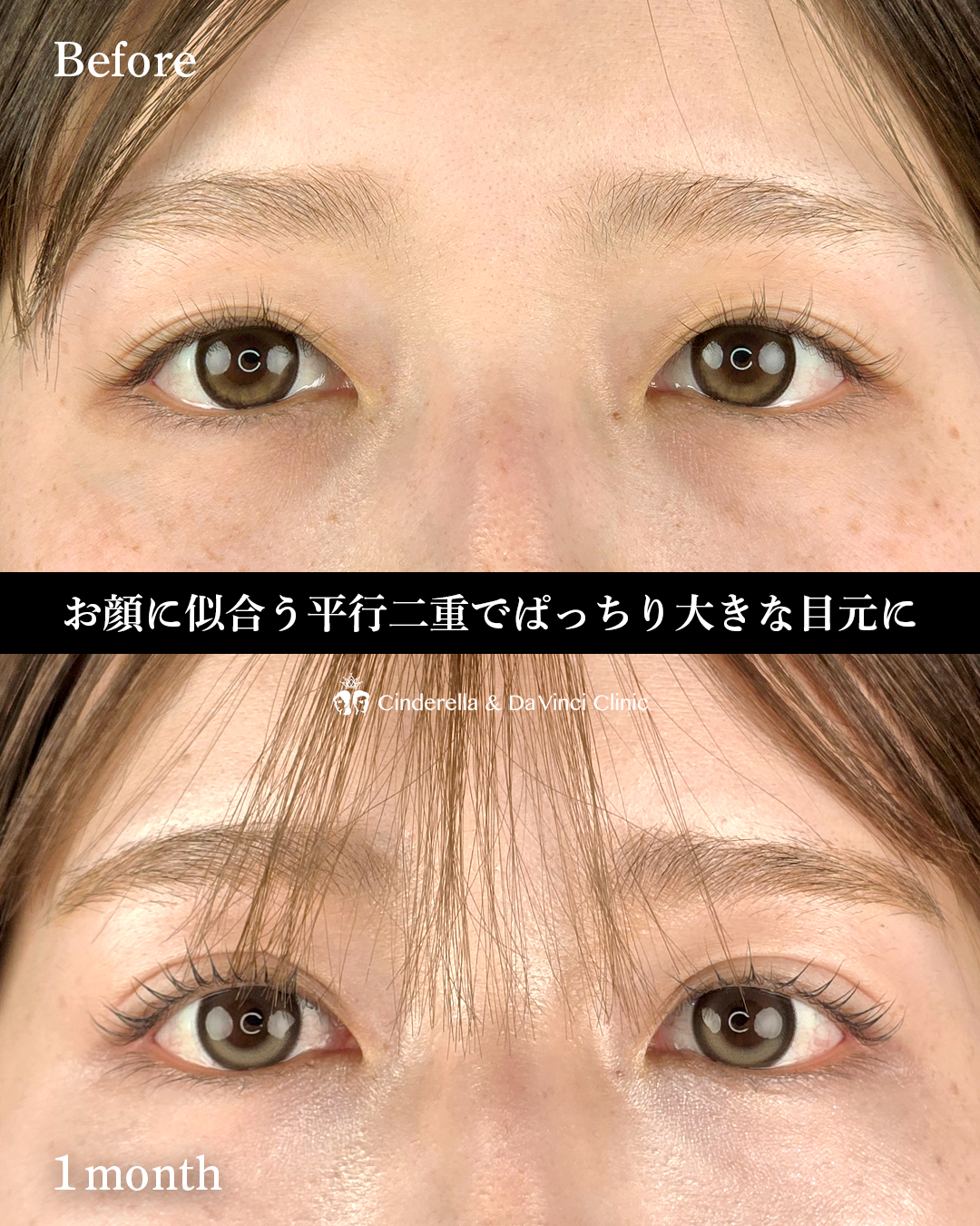 埋没で平行二重の画像