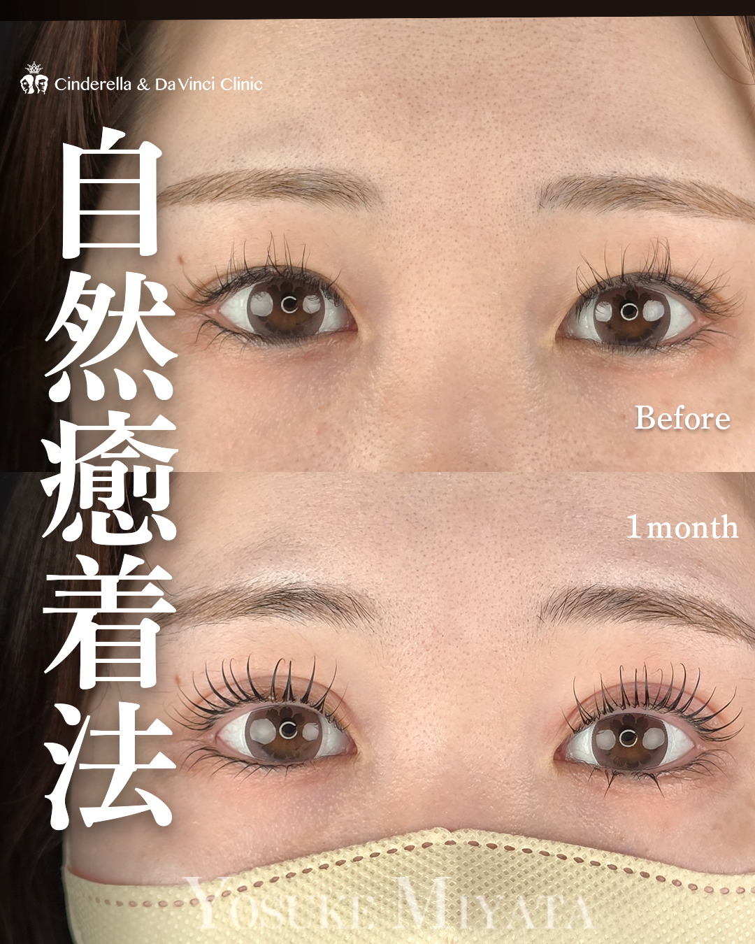 幅広の平行二重