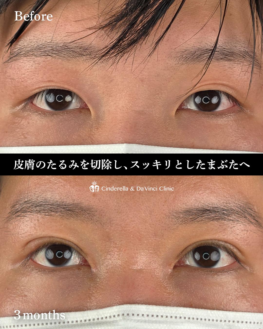 まぶたのたるみを切開で取るの画像