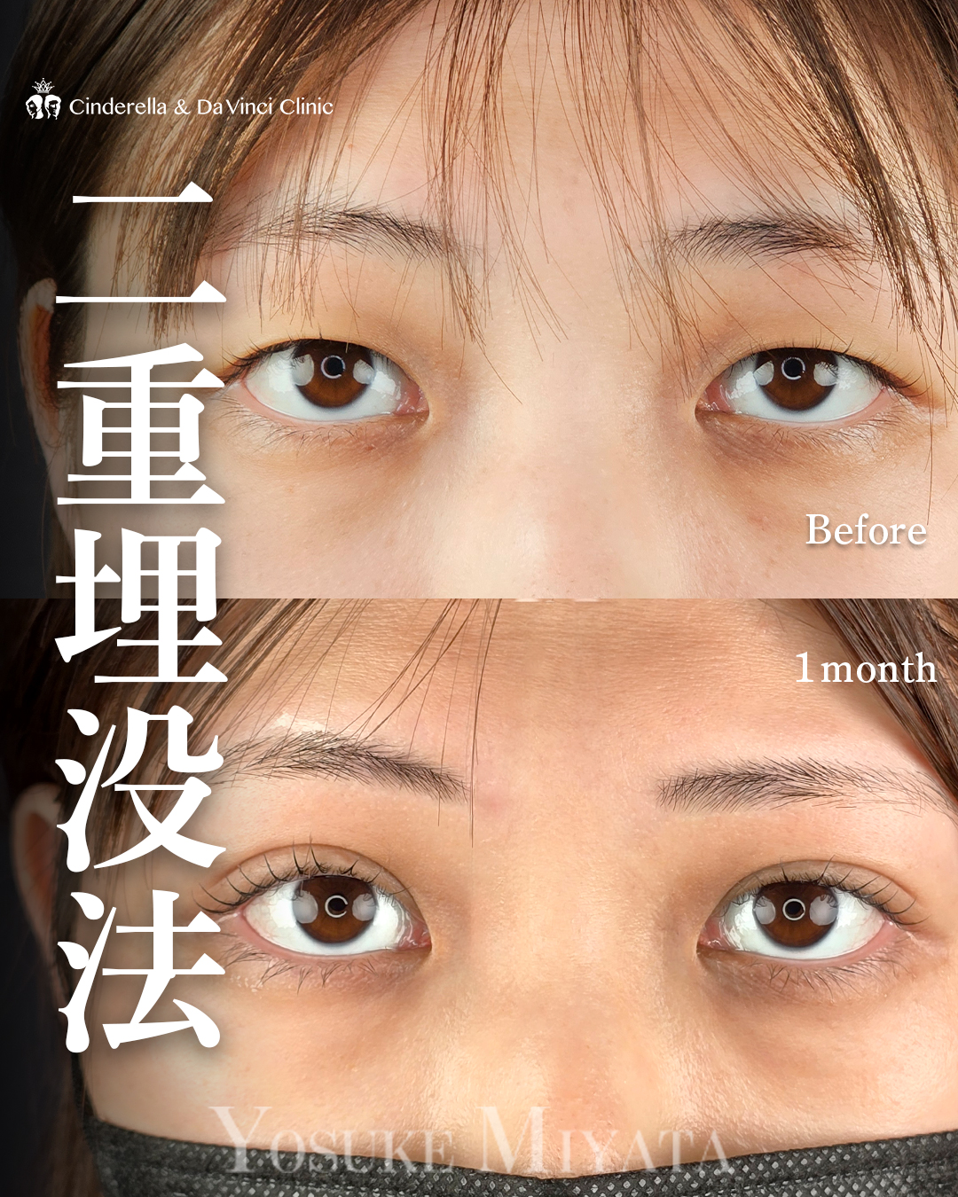 自分に似合う二重幅