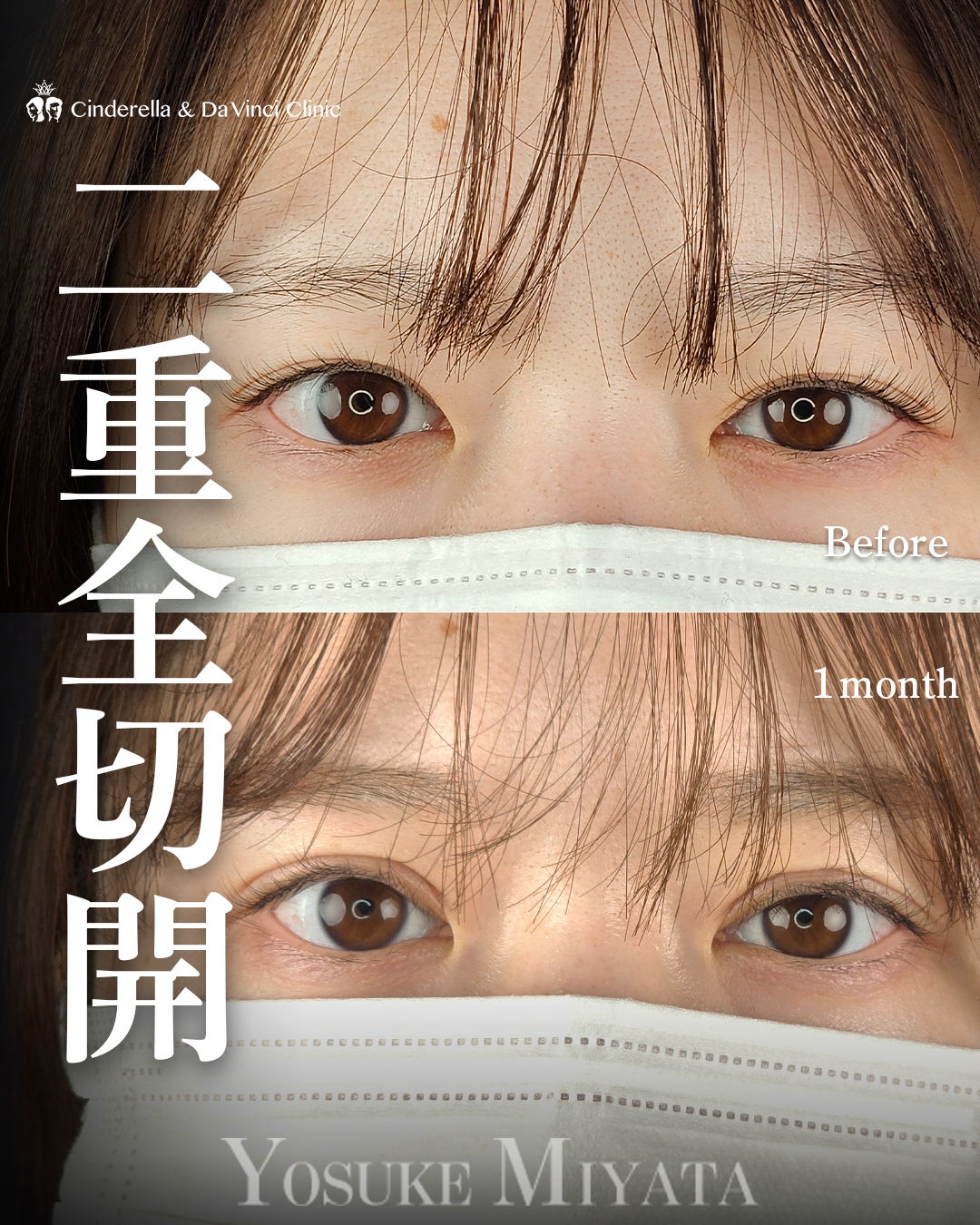 切開で二重をつくる