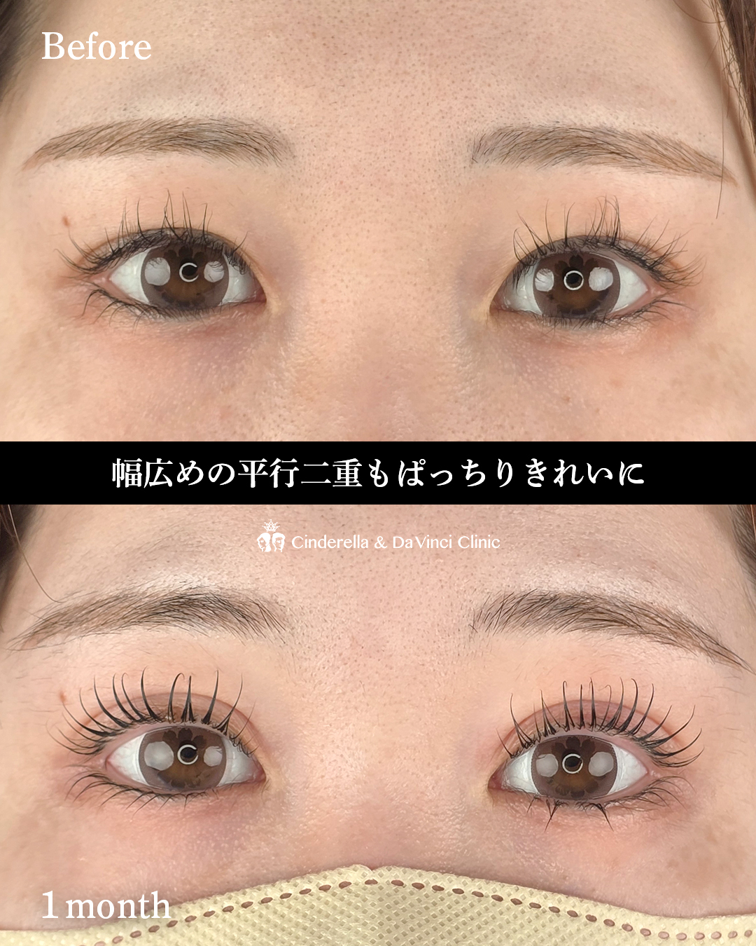幅広の平行二重の画像