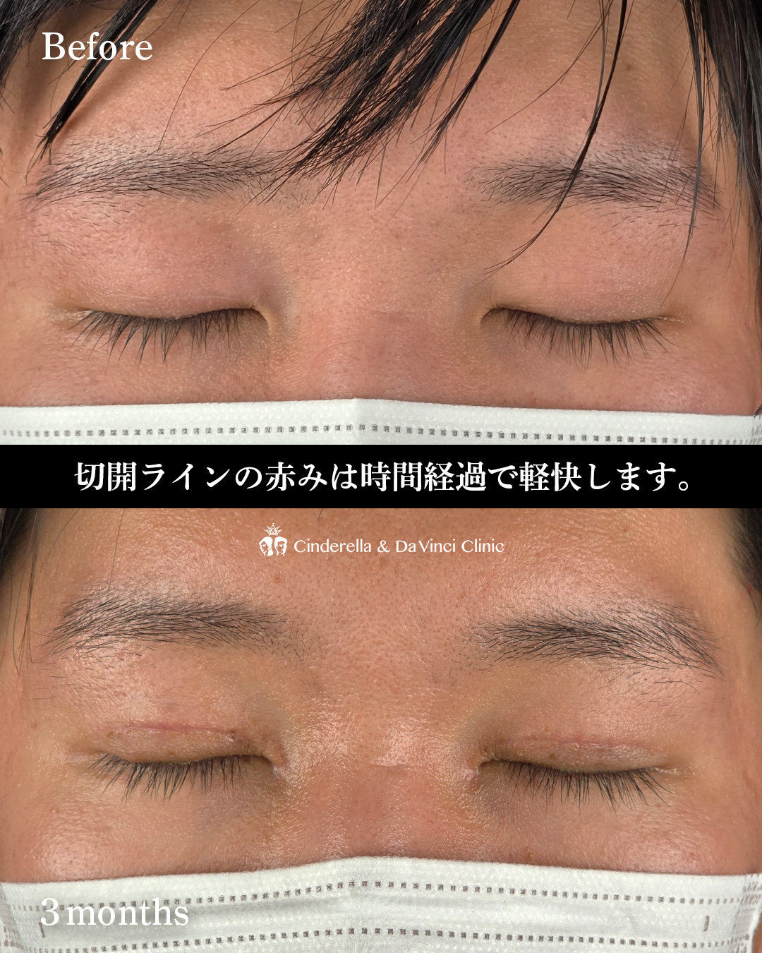 まぶたのたるみを切開で取るの画像