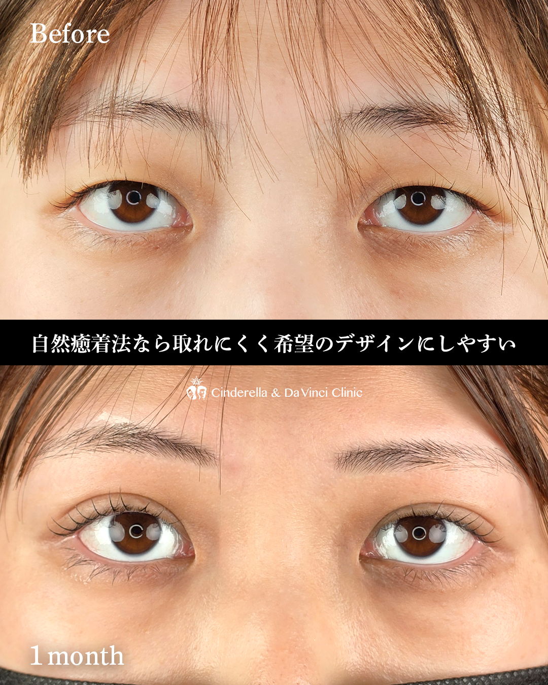 自分に似合う二重幅の画像