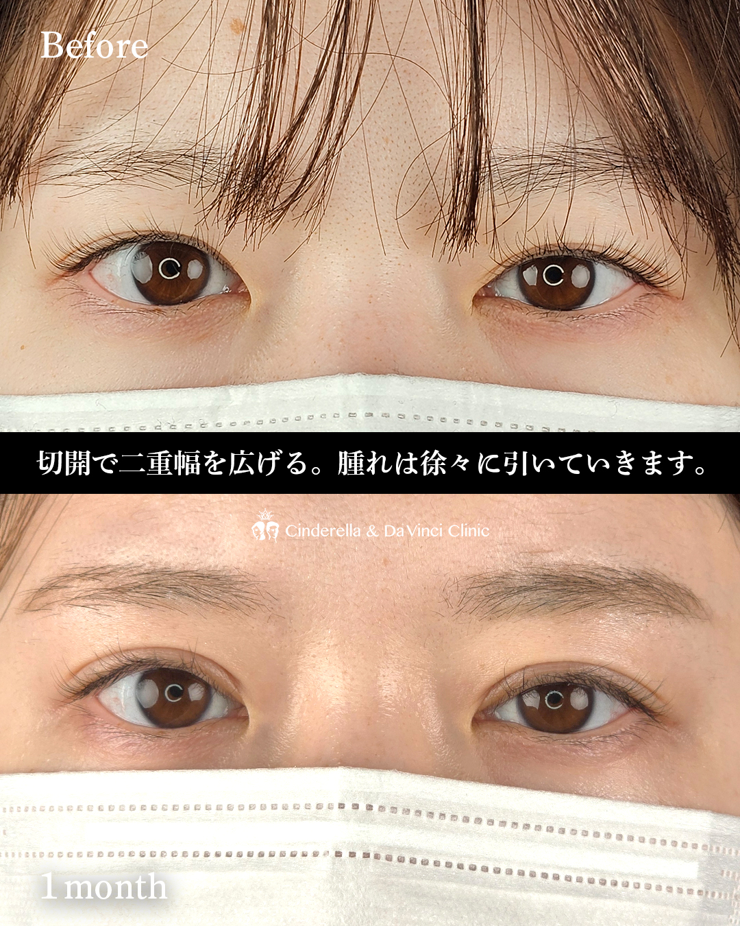 切開で二重をつくるの画像