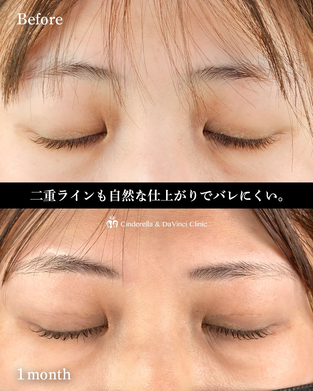 自分に似合う二重幅の画像
