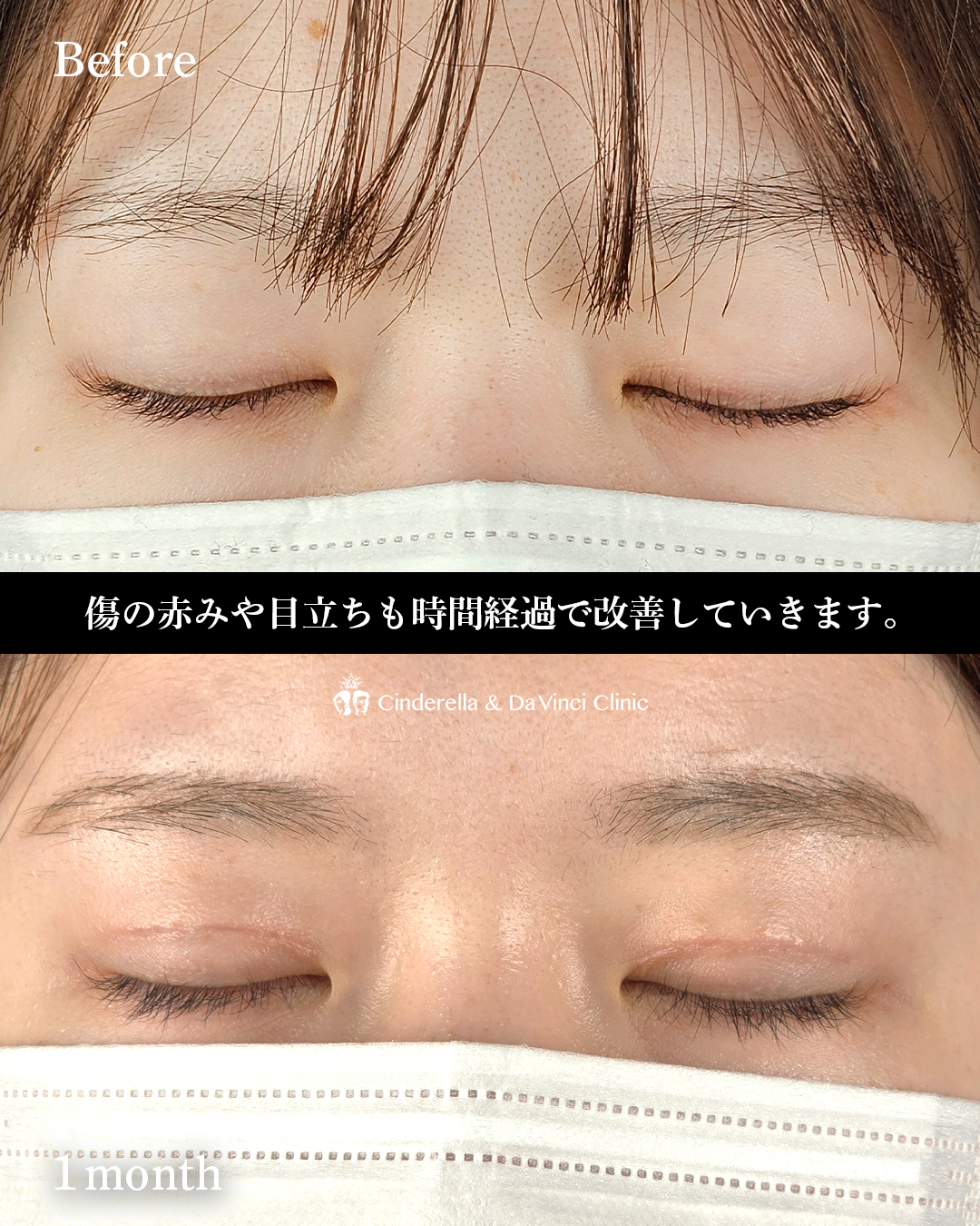 切開で二重をつくるの画像