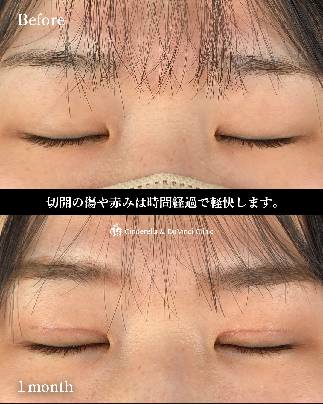 二重切開で末広二重の画像