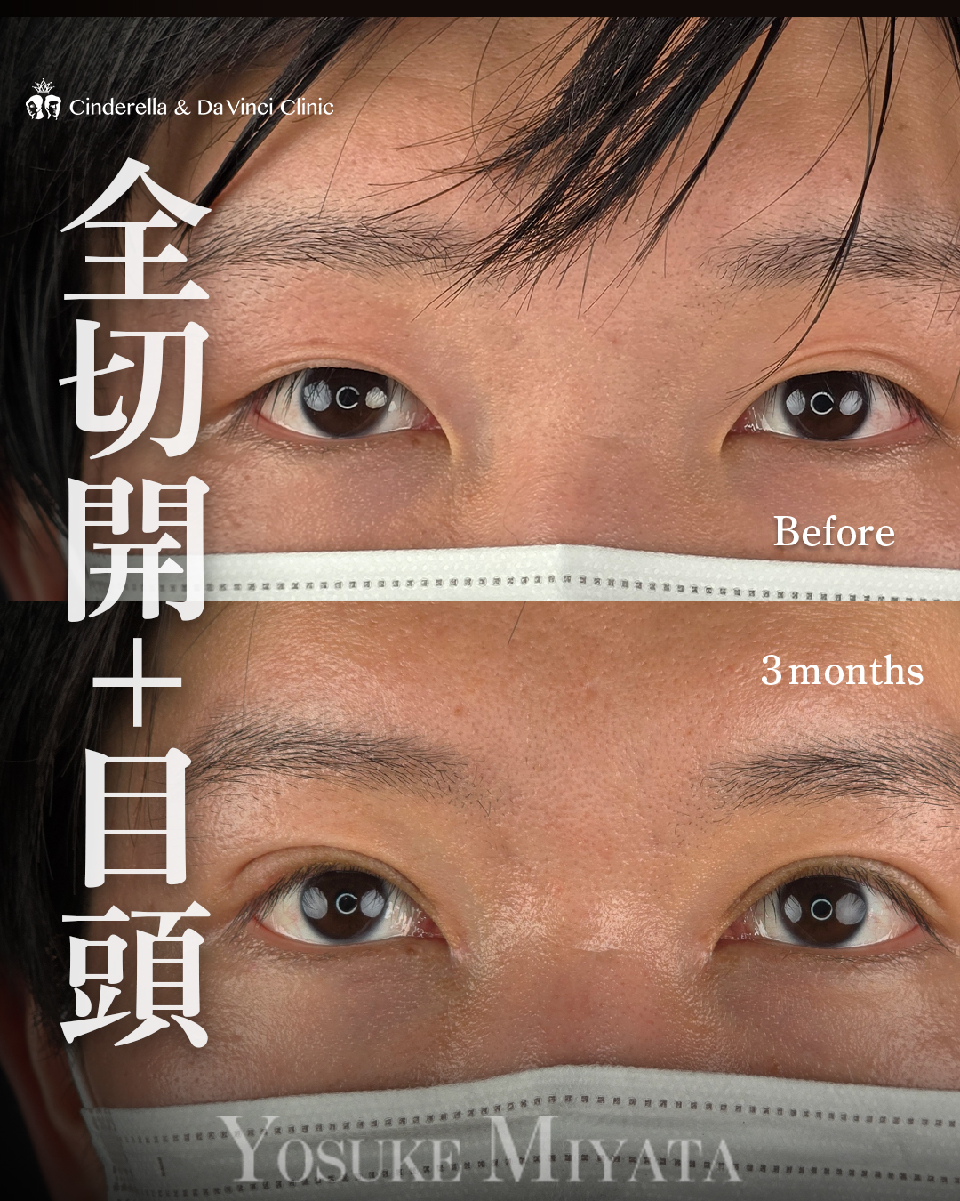 まぶたのたるみを切開で取る