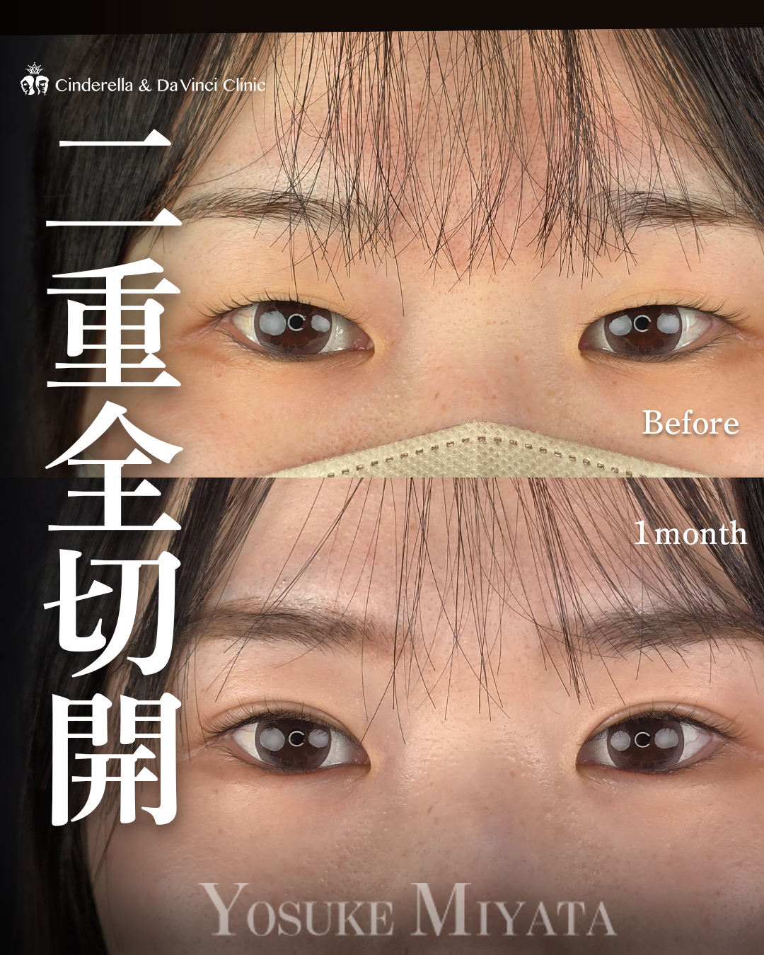 二重切開で末広二重