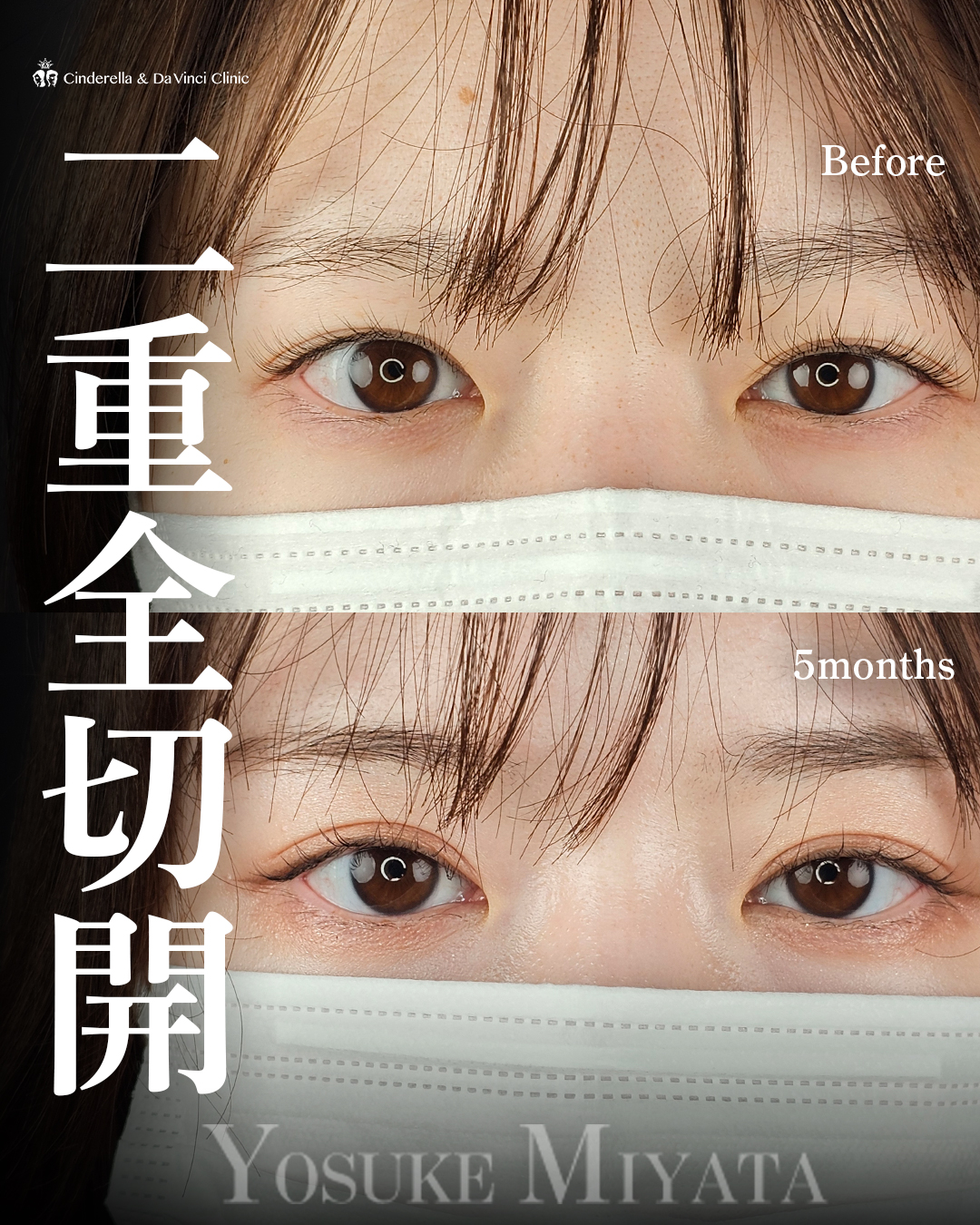 切開で二重をつくるの画像