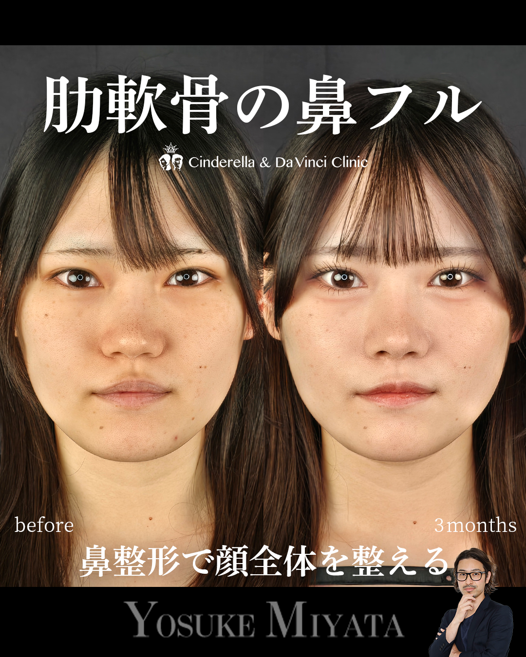 鼻フル×中顔面