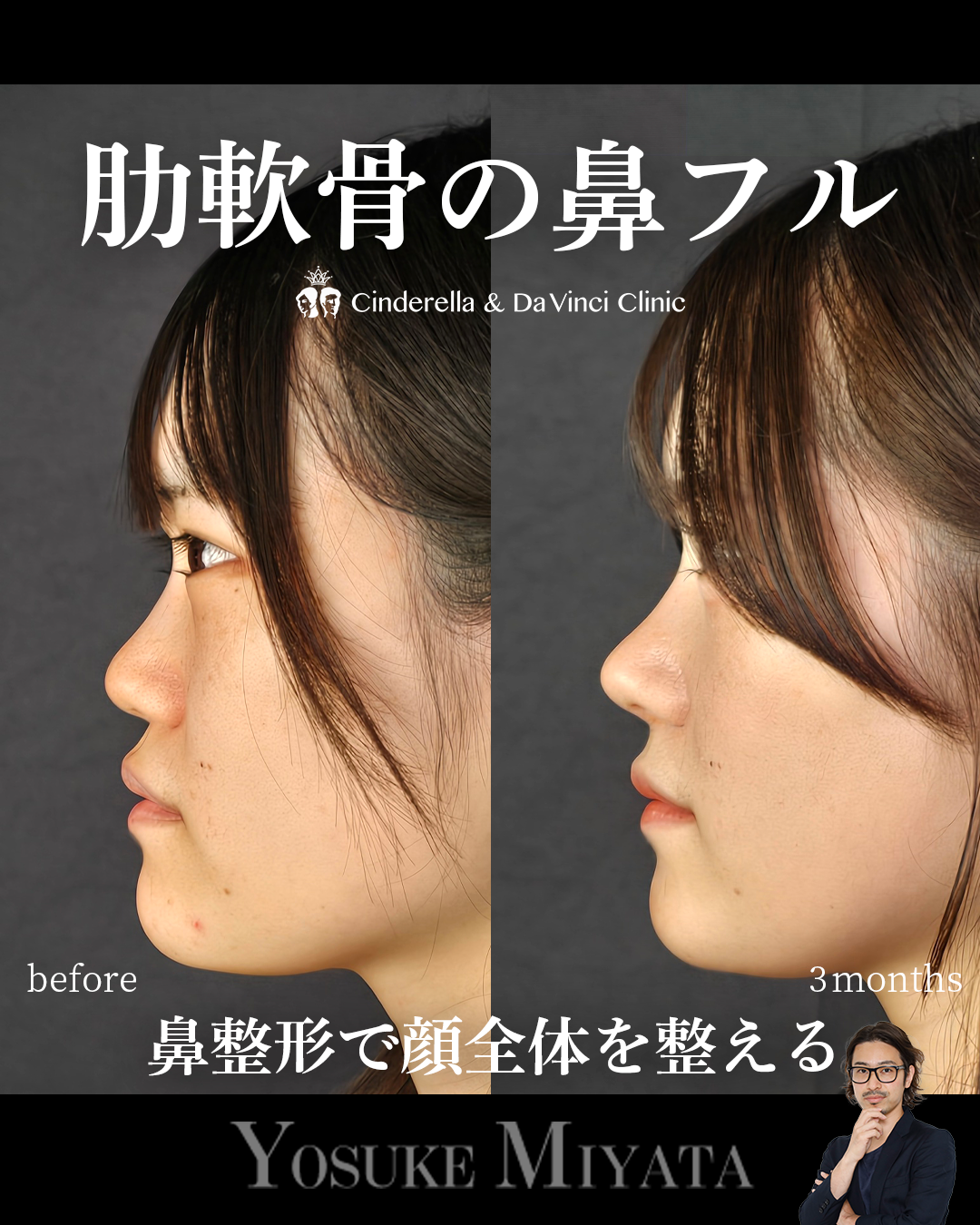 鼻フル×中顔面の画像
