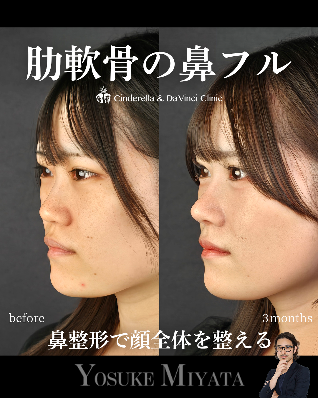 鼻フル×中顔面の画像