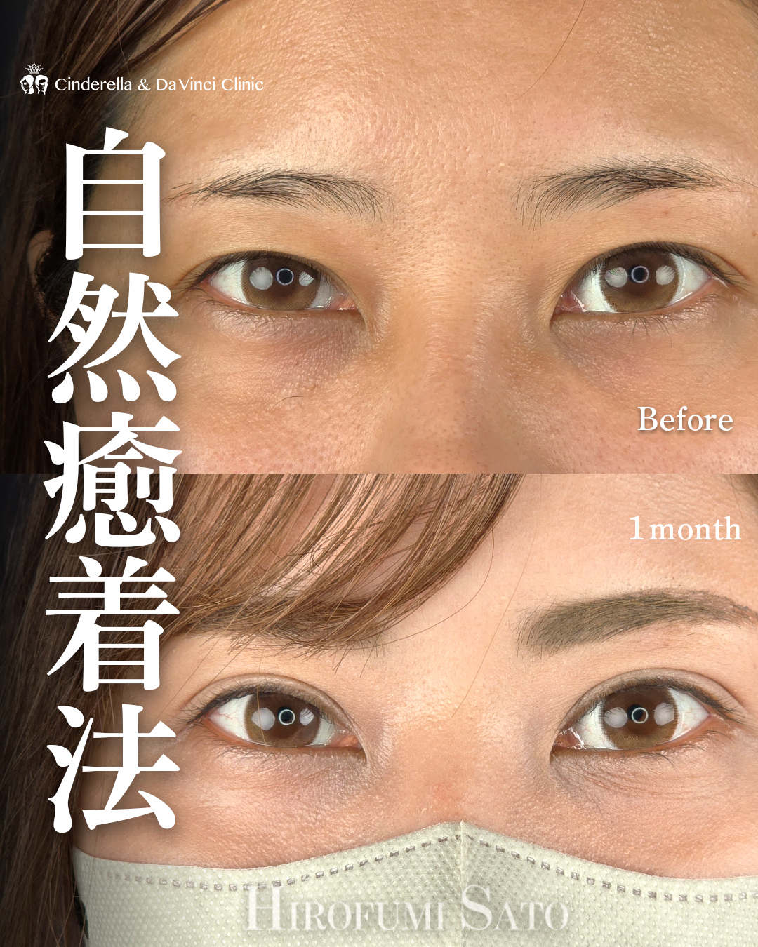 埋没の留めなおしを自然癒着で