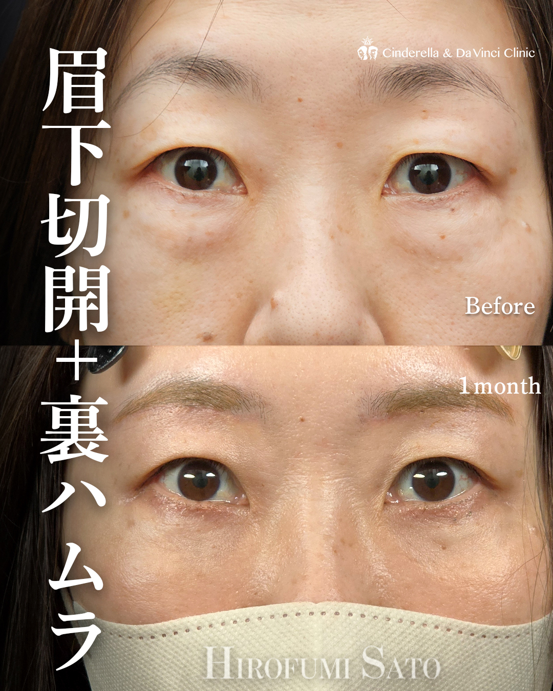 眉下切開とハムラ法