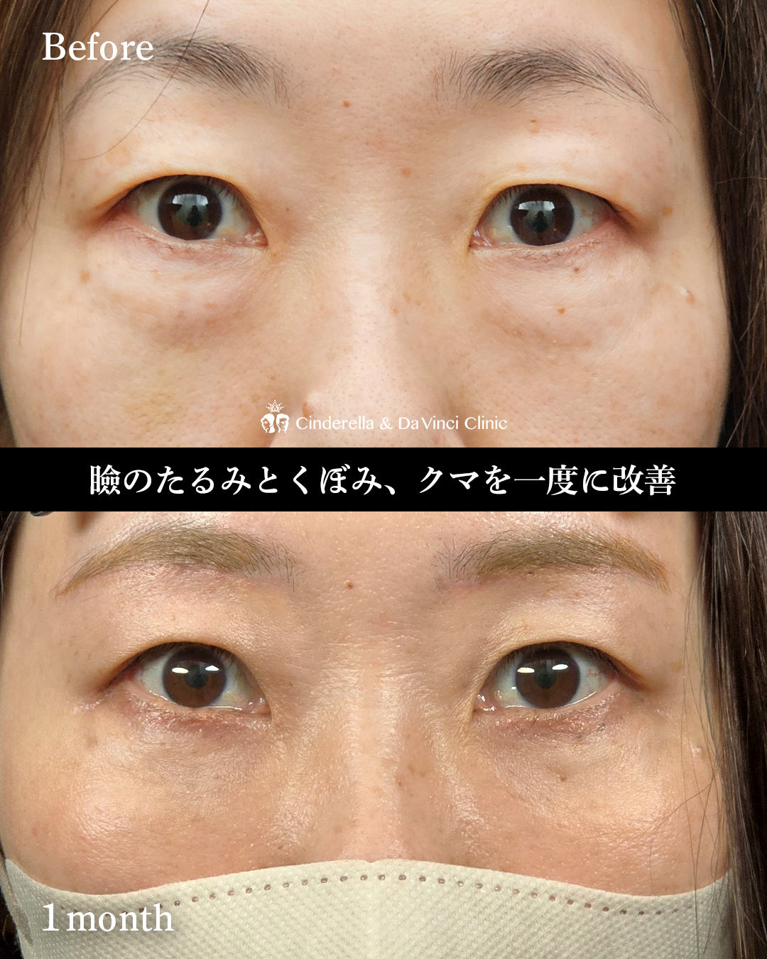眉下切開とハムラ法の画像