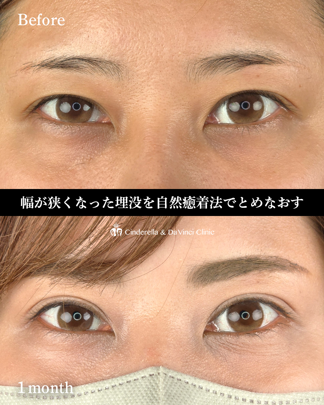 埋没の留めなおしを自然癒着での画像