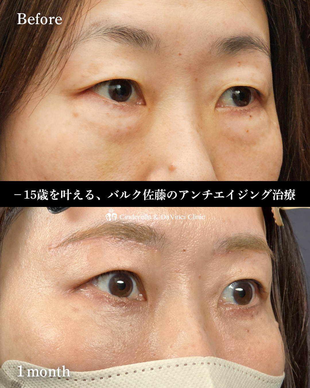眉下切開とハムラ法の画像