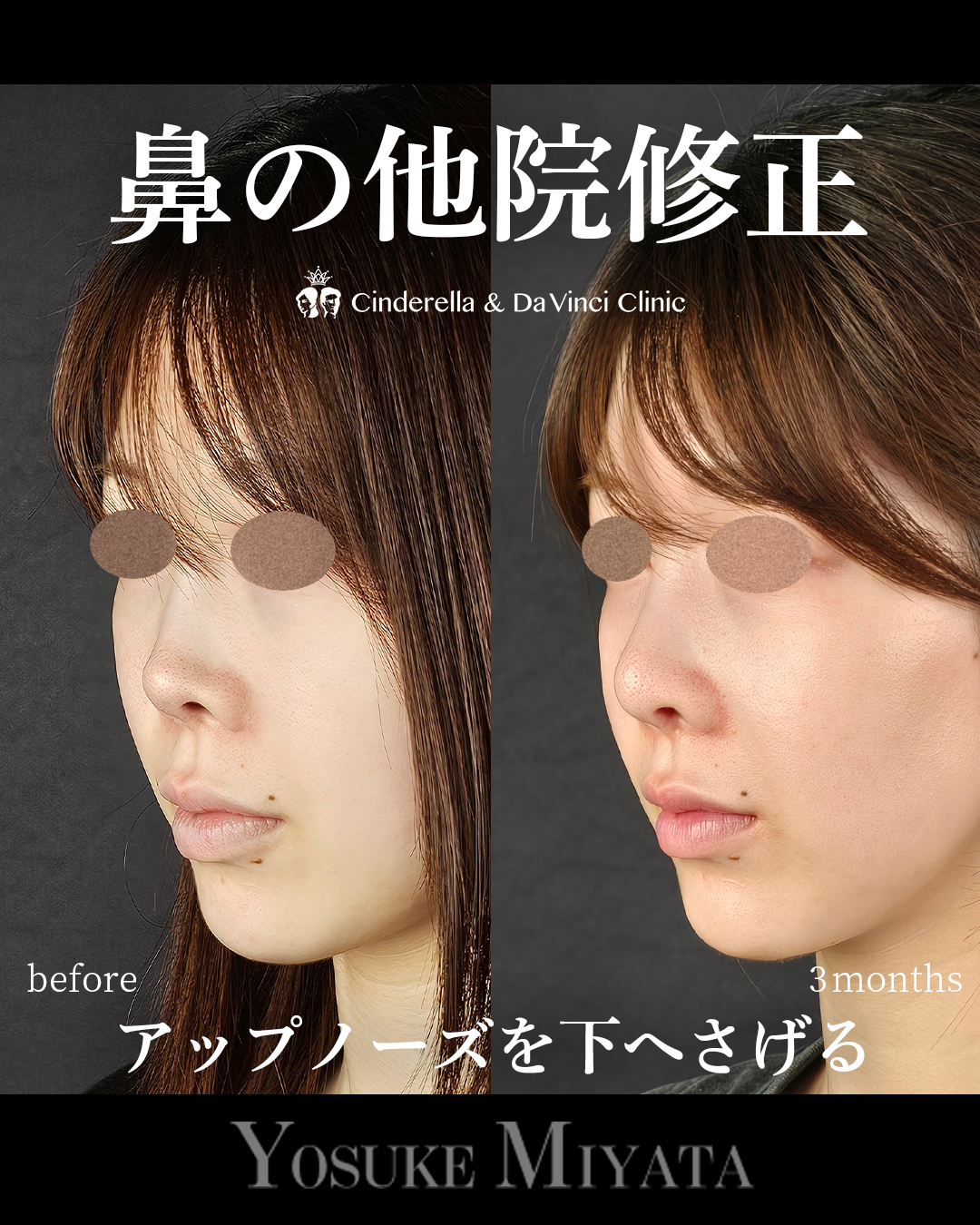 アップノーズ修正の画像