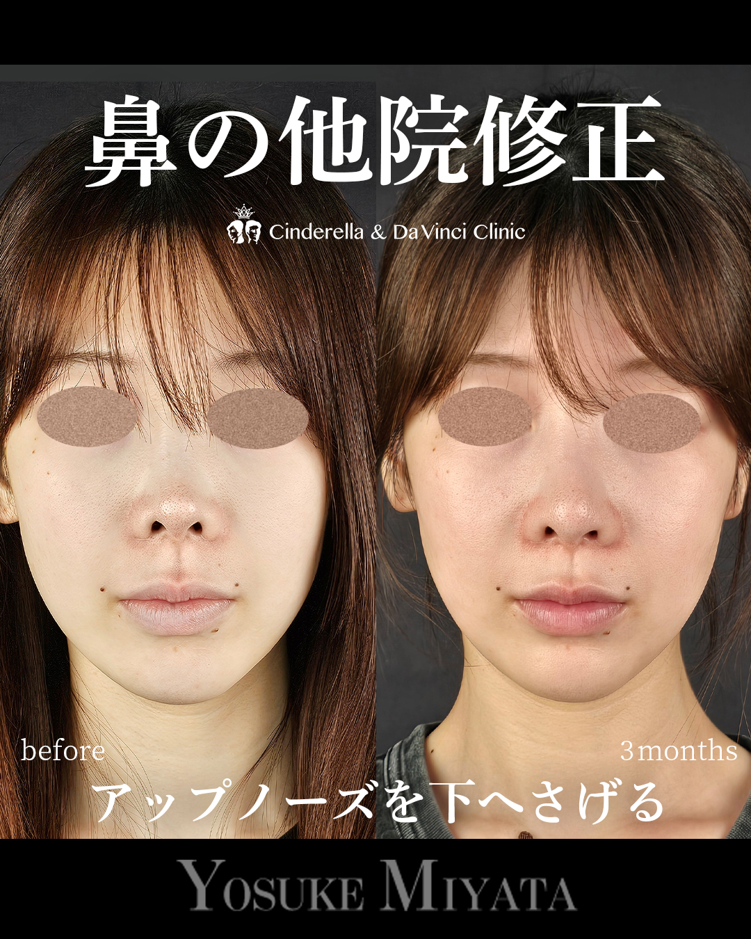 アップノーズ修正の画像
