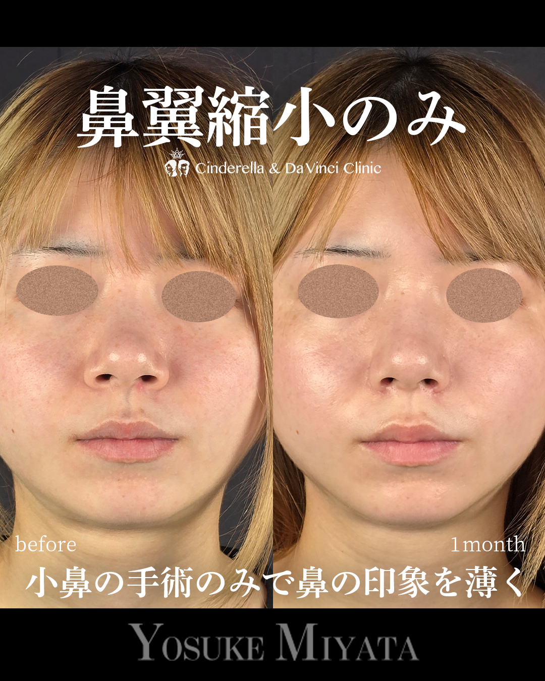 鼻翼縮小のみで忘れ鼻