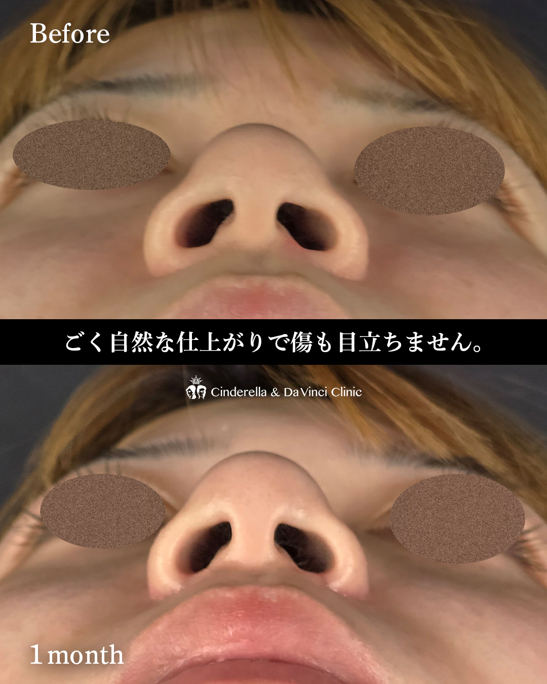 鼻翼縮小のみで忘れ鼻の画像