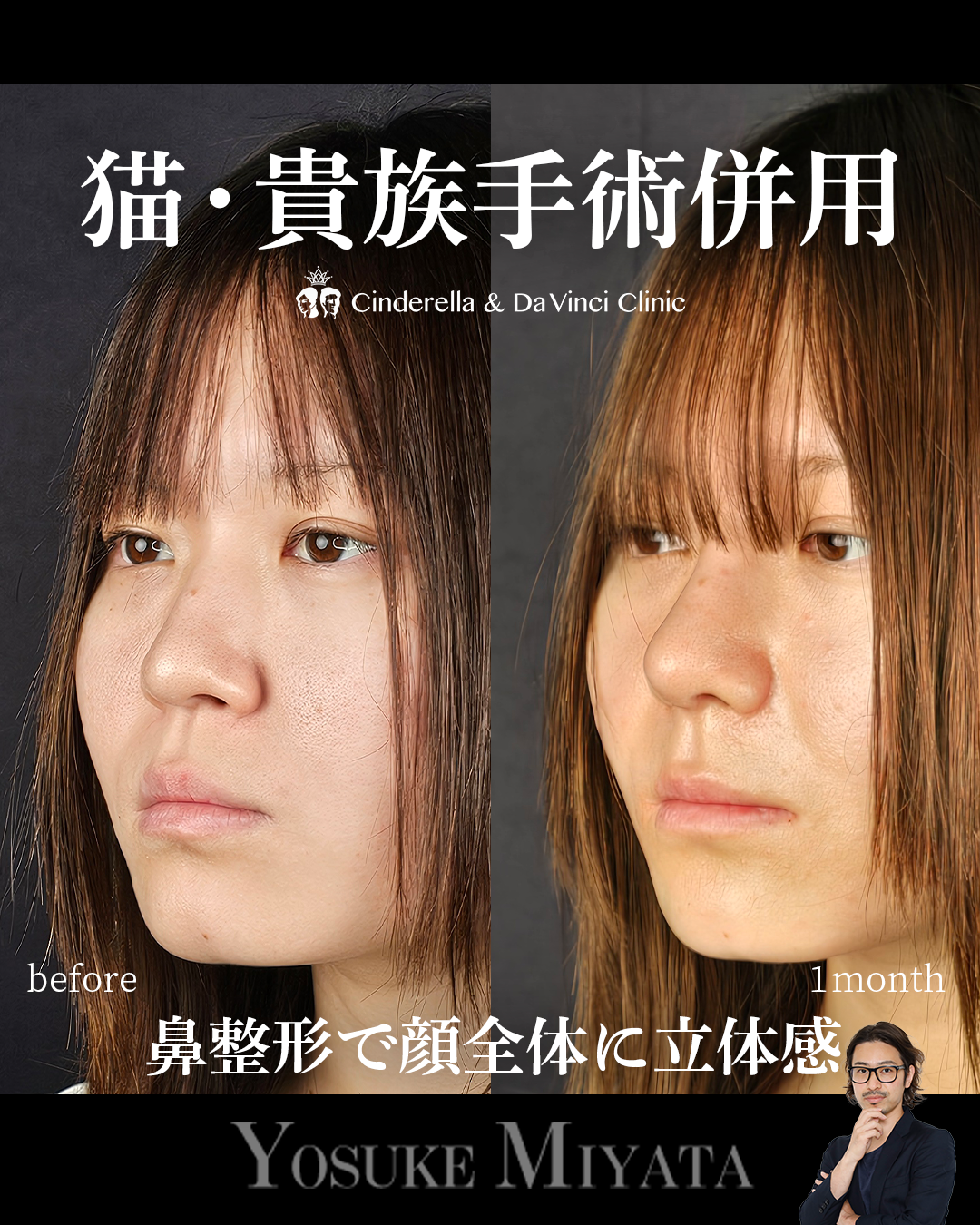 鼻整形のみで垢抜けの画像