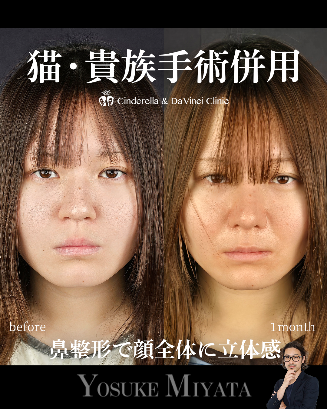 鼻整形のみで垢抜けの画像