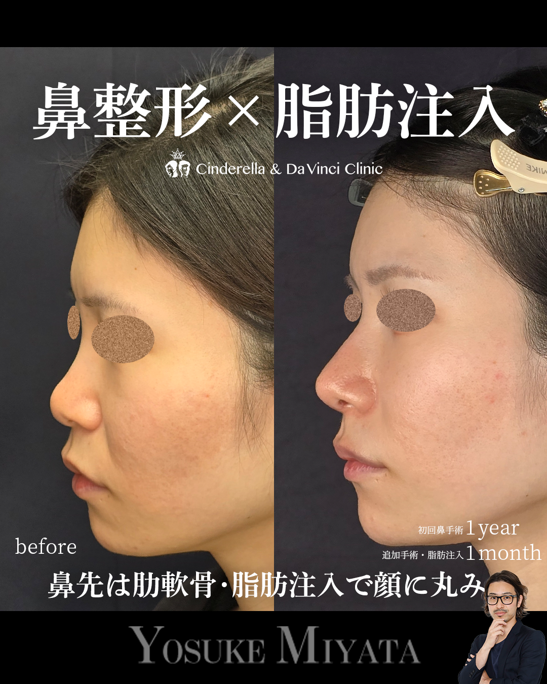 鼻整形と脂肪注入