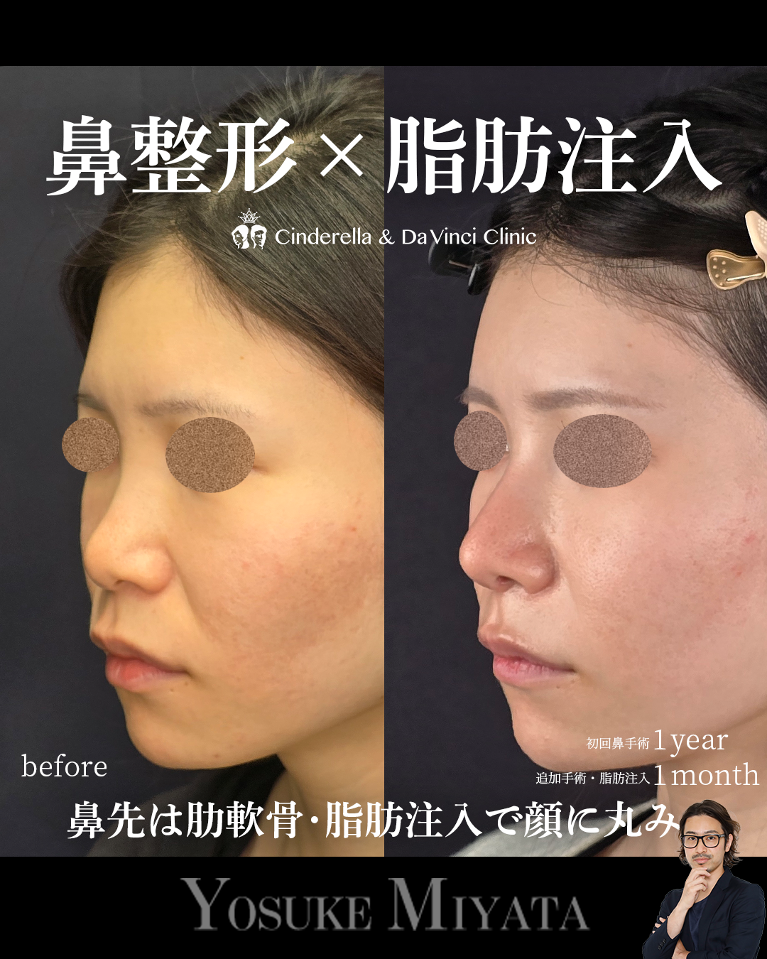 鼻整形と脂肪注入の画像