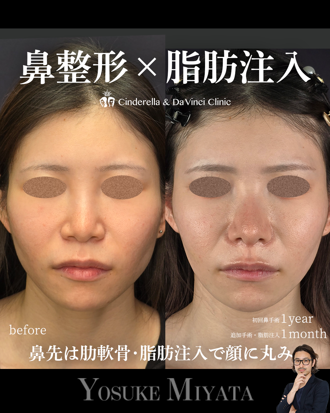 鼻整形と脂肪注入の画像
