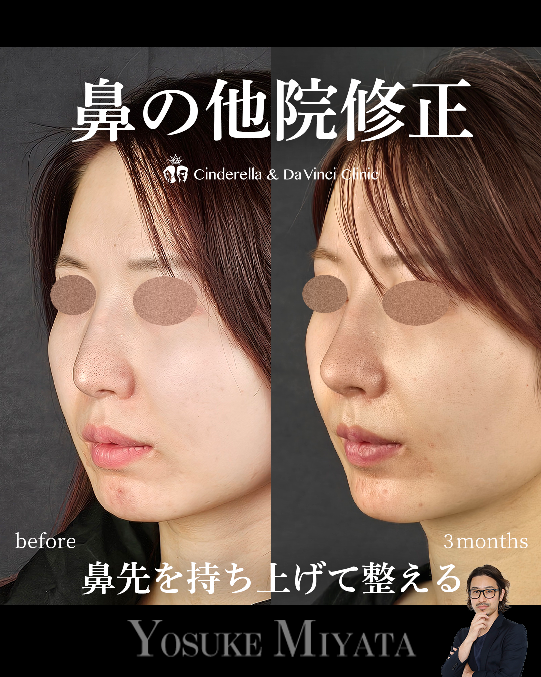 鼻の他院修正の画像