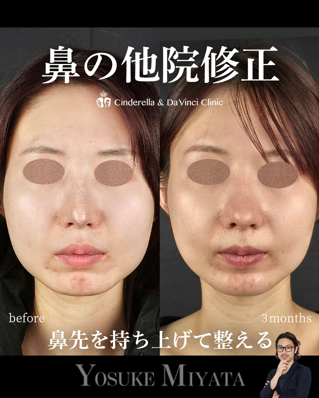 鼻の他院修正の画像