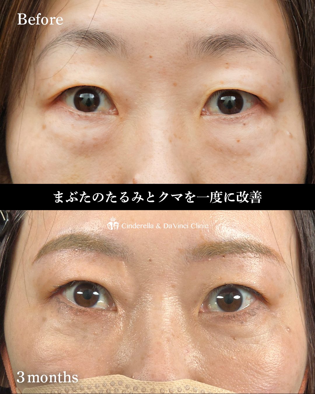 眉下切開とハムラ法の画像