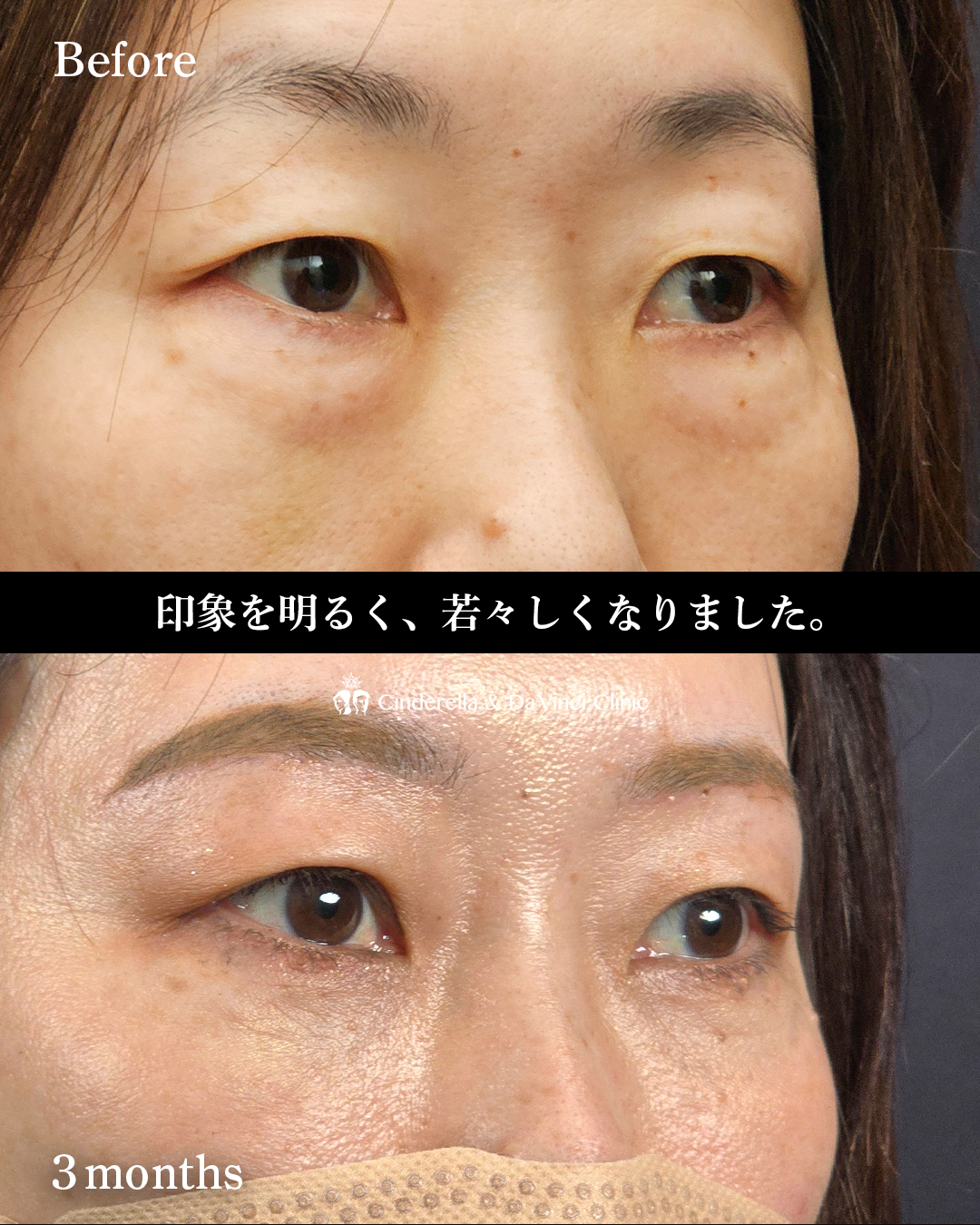 眉下切開とハムラ法の画像