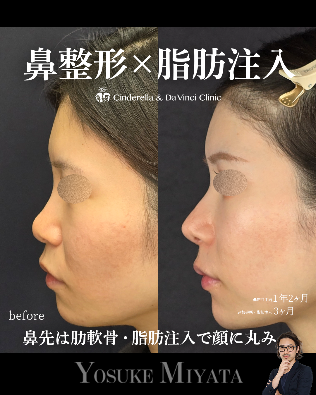 鼻整形と脂肪注入の画像