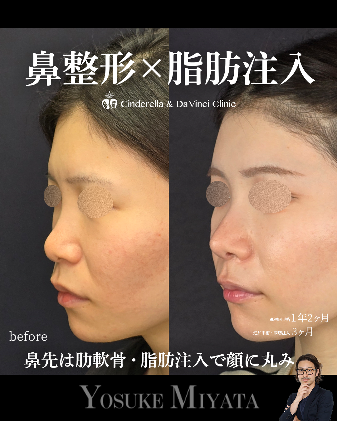 鼻整形と脂肪注入の画像