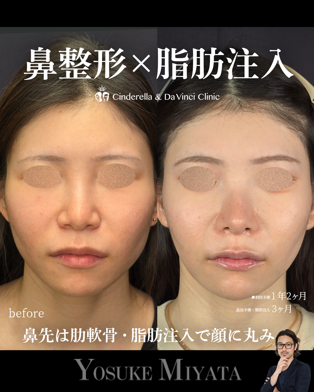 鼻整形と脂肪注入の画像