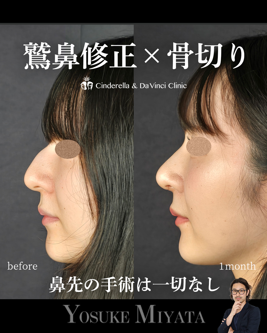 鷲鼻と骨切りのみ